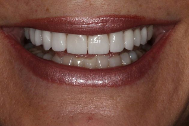 Cosmetic Dentistry Case 1 - After
