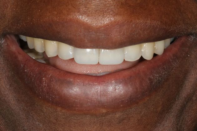 Cosmetic Dentistry Case 5 - After