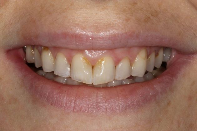 Cosmetic Dentistry Case 4 - Before