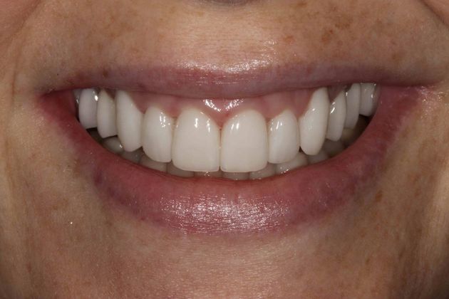 Cosmetic Dentistry Case 4 - After