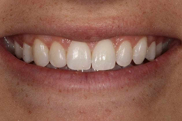Cosmetic Dentistry Case 6 - After