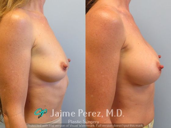 Breast Augmentation: 41-year-old female: Silicone Breast Augmentation - Before & After