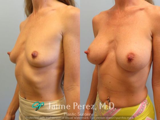Breast Augmentation: 41-year-old female: Silicone Breast Augmentation - Before & After