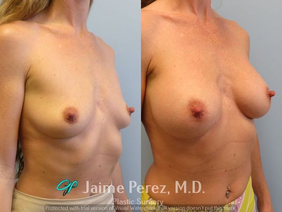 Breast Augmentation: 41-year-old female: Silicone Breast Augmentation - Before & After