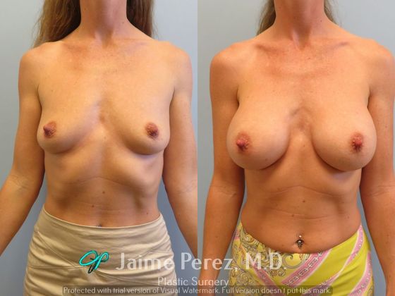 Breast Augmentation: 41-year-old female: Silicone Breast Augmentation - Before & After