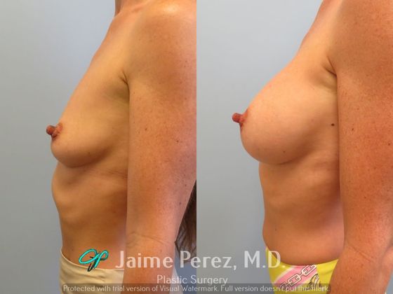 Breast Augmentation: 41-year-old female: Silicone Breast Augmentation - Before & After