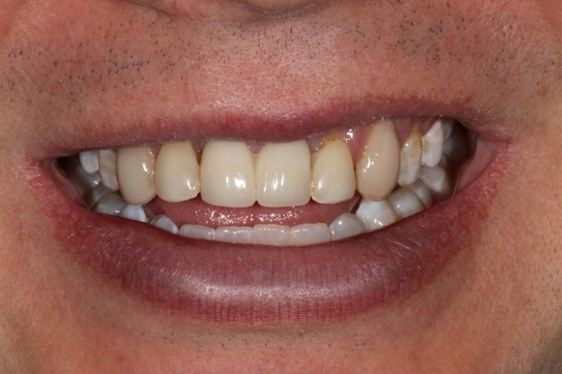 Dental Implants Case 4 - Before