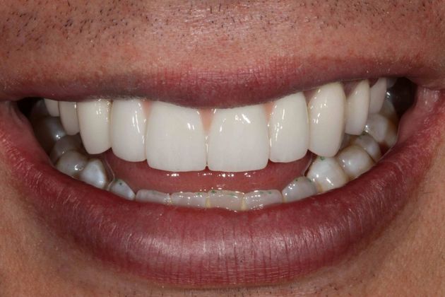 Dental Implants Case 4 - After
