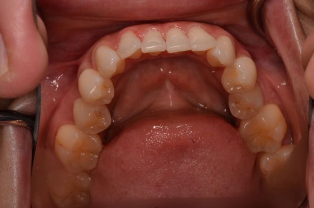 Invisalign: Case 10 - Before