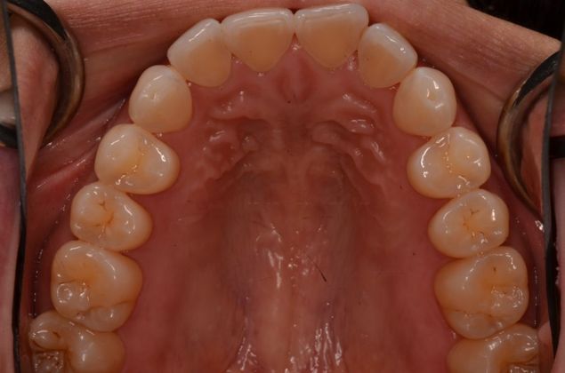 Invisalign: Case 10 - Before