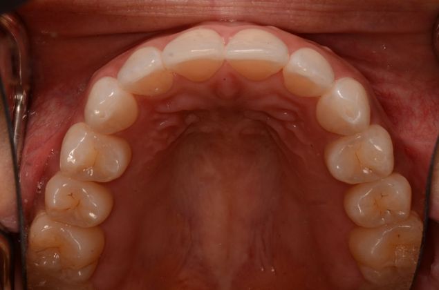 Invisalign: Case 10 - After