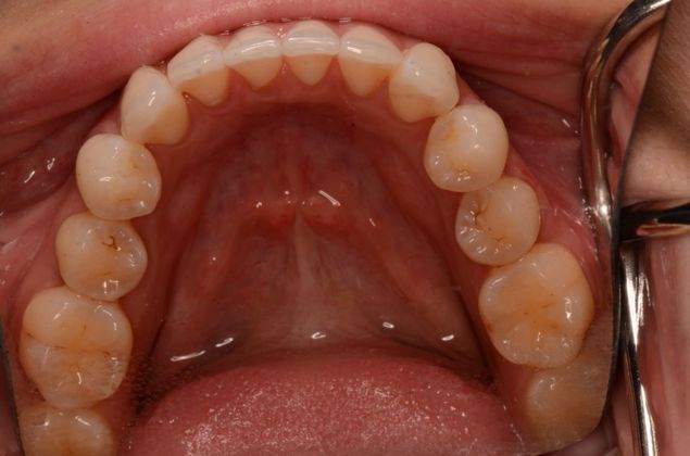Invisalign: Case 10 - After