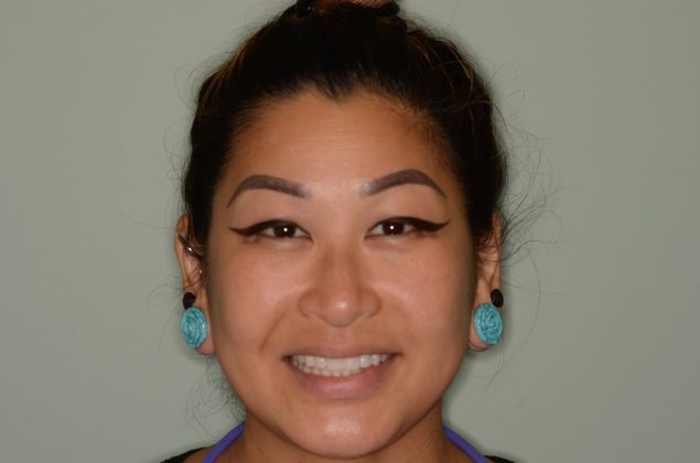 Invisalign: Case 10 - After