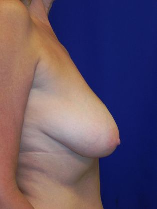 Breast Lift / Mastopexy: Case 30 (22337) - After