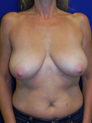 Breast Lift / Mastopexy Case 30 (22337) - Before