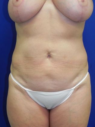 Body Mommy Make-Over Case 4 (22337) - After