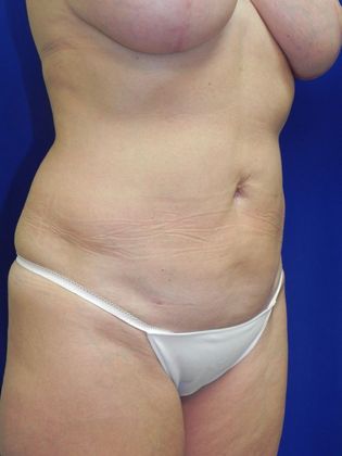 Body Mommy Make-Over: Case 4 (22337) - After