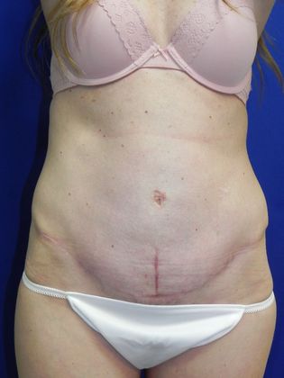 Body Diastasis Recti - Abdominal Muscle Separation: Case 1 (21948) - After