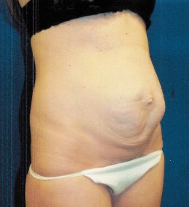 Body Tummy Tuck / Abdominoplasty: Case 17 - Before