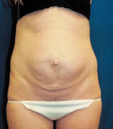 Body Tummy Tuck / Abdominoplasty: Case 17 - Before