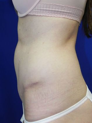 Body Tummy Tuck / Abdominoplasty: Case 17 - After