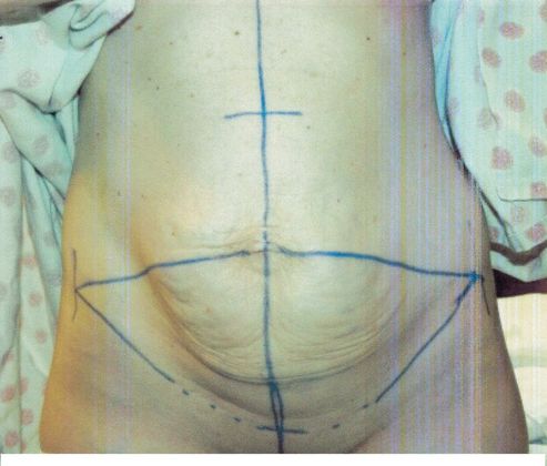 Body Tummy Tuck / Abdominoplasty: Case 17 - Before