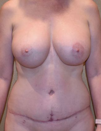 Mommy Makeover Case 131 - After