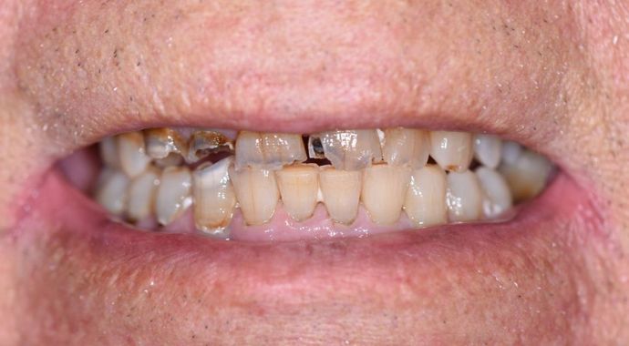 Tooth-colored Fillings Case 1 - Victoria, TX - Before