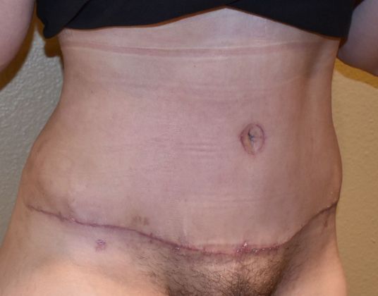 Tummy Tuck (Abdominoplasty): Case 193 - After
