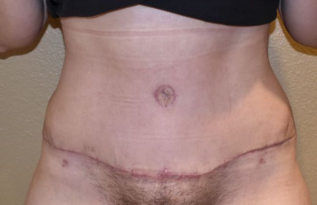 Tummy Tuck (Abdominoplasty): Case 193 - After