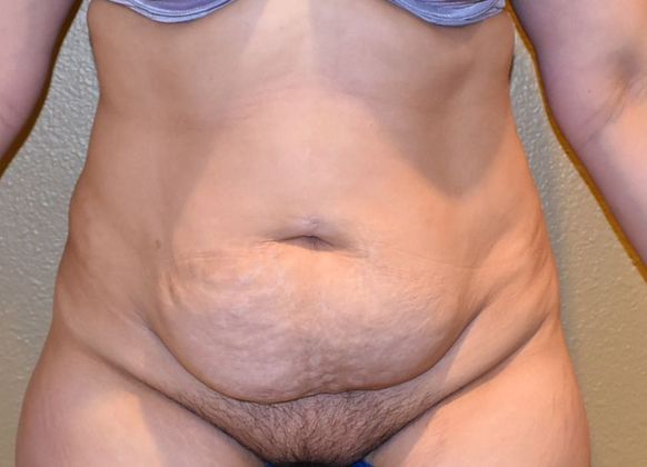 Tummy Tuck (Abdominoplasty): Case 193 - Before