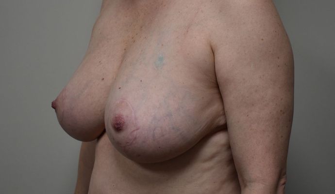 Breast Lift (Mastopexy): Case 66 - After