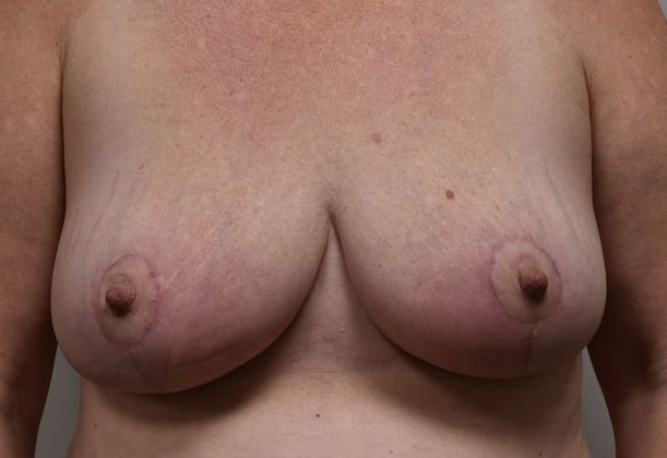 Breast Lift (Mastopexy) Case 67 - After