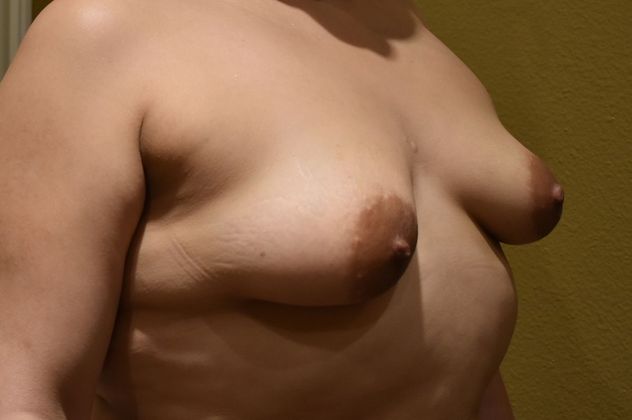 Breast Augmentation w/ Lift: Case 266 - Before