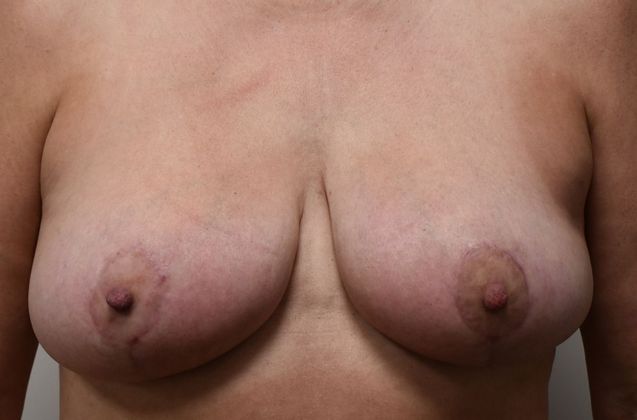 Breast Lift (Mastopexy) Case 70 - After