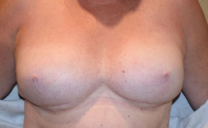 Breast Reconstruction Case 67 - After