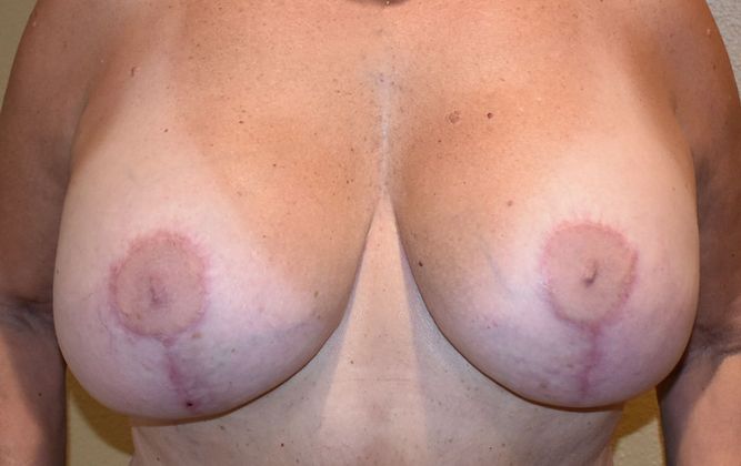 Breast Augmentation w/ Lift: Case 267 - After
