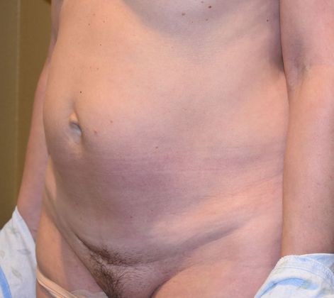 Tummy Tuck (Abdominoplasty): Case 194 - Before