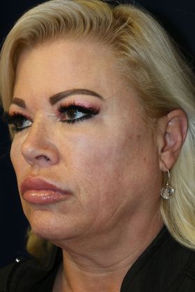 PDO Threads: Case 8 - After