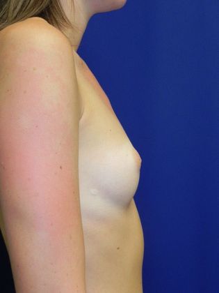 Breast Augmentation : Case 68 (18753) - Before