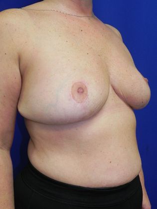 Breast Reduction: Case 30 - After
