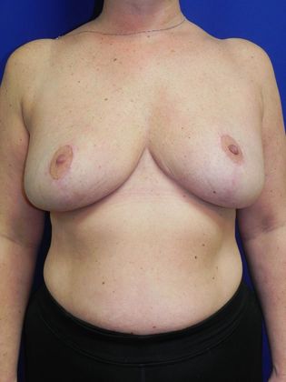 Breast Reduction Case 30 - After