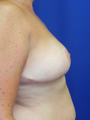 Breast Reduction: Case 30 - After