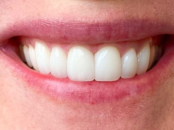 Smile Makeovers: Case 8 - After