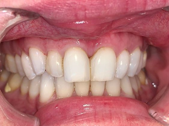 Smile Makeovers: Case 8 - Before