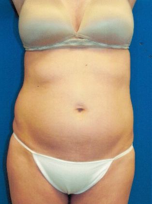 Body Liposuction: Case 9 (20145) - Before, waist contouring