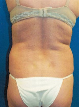 Body Liposuction: Case 9 (20145) - Before, waist contouring