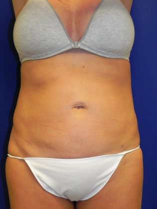 Body Liposuction: Case 9 (20145) - After