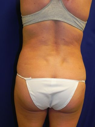 Body Liposuction: Case 9 (20145) - After