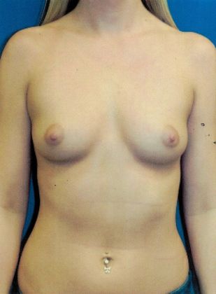 Breast Augmentation  Case 70 (20999) - Before